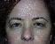 Eyelid Surgery Picture