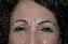 Botulinum Toxin Picture
