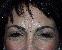 Botulinum Toxin Picture