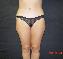 Tummy Tuck Picture