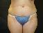 Tummy Tuck Picture