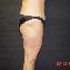 Tummy Tuck Picture
