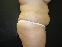 Tummy Tuck Picture