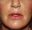 Injectable Fillers Picture