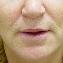 Injectable Fillers Picture