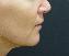 Injectable Fillers Picture