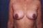 Breast Augmentation Picture