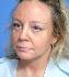 Facelift Picture