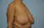 Breast Reduction Picture