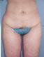 Liposuction Picture