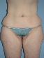 Liposuction Picture