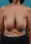 Breast Lift Picture