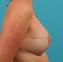 Breast Reconstruction Picture