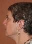 Ear Surgery Picture