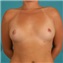 Breast Augmentation Picture