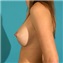 Breast Augmentation Picture