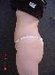 Tummy Tuck Picture