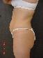 Tummy Tuck Picture