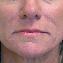 Injectable Fillers Picture