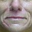 Injectable Fillers Picture