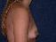 Breast Augmentation Picture