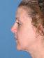 Injectable Fillers Picture