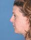 Injectable Fillers Picture