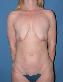 Tummy Tuck Picture
