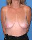 Breast Reduction Picture