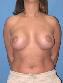 Breast Augmentation Picture