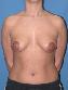 Breast Augmentation Picture