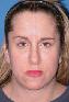 Eyelid Surgery Picture