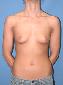 Breast Augmentation Picture