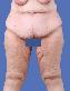 Body Contouring After Major Weight Loss Picture
