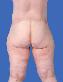 Body Contouring After Major Weight Loss Picture