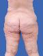 Body Contouring After Major Weight Loss Picture