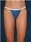 Liposuction Picture