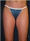 Liposuction Picture