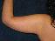 Arm Lift Picture