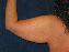 Arm Lift Picture
