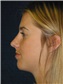 Nose Surgery Picture