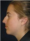Nose Surgery Picture