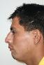 Nose Surgery Picture