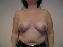 Breast Reduction Picture