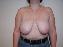 Breast Reduction Picture