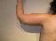 Arm Lift Picture
