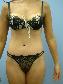 Tummy Tuck Picture