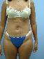 Tummy Tuck Picture
