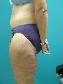 Body Contouring After Major Weight Loss Picture