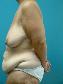Body Contouring After Major Weight Loss Picture